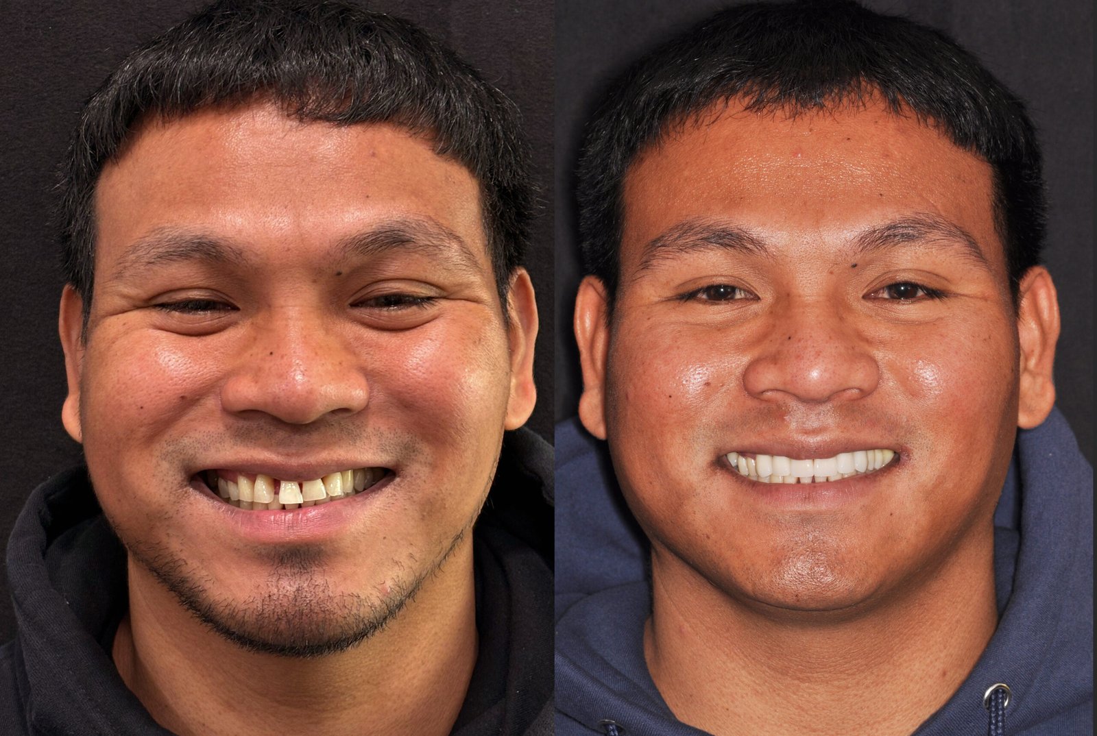 before and after crowns treatment