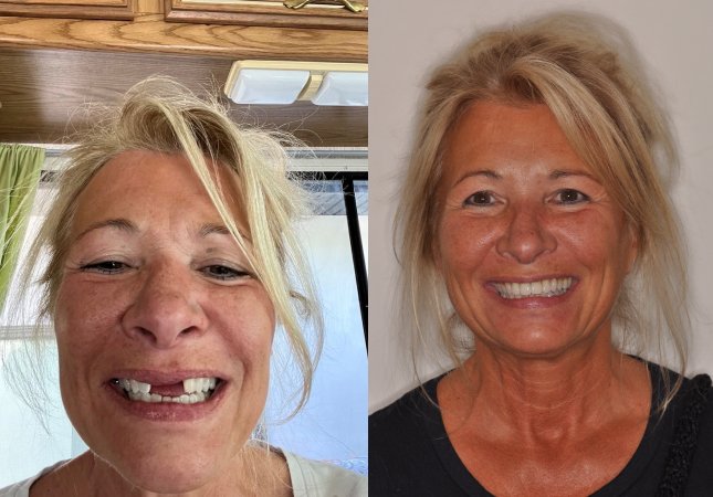 dental crowns before and after treatment