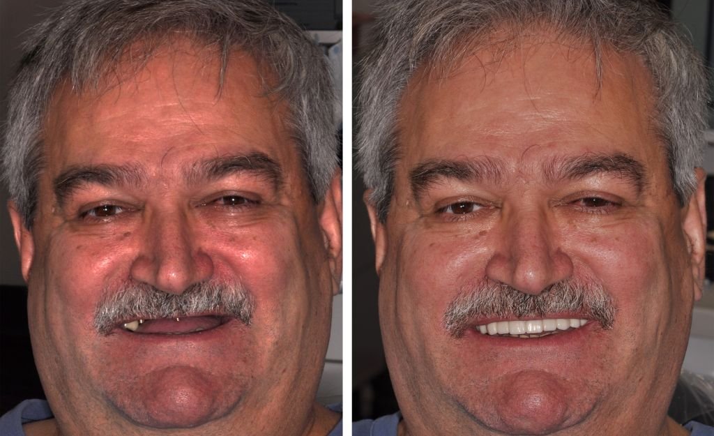 lance taylor before and after fixed implants