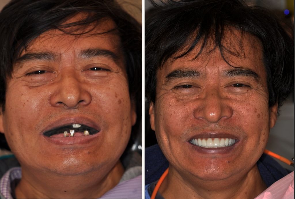 simon before and after treatment
