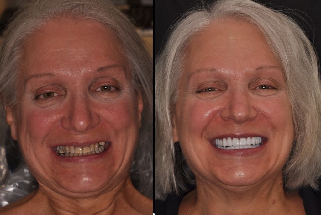 sue before and after treatment