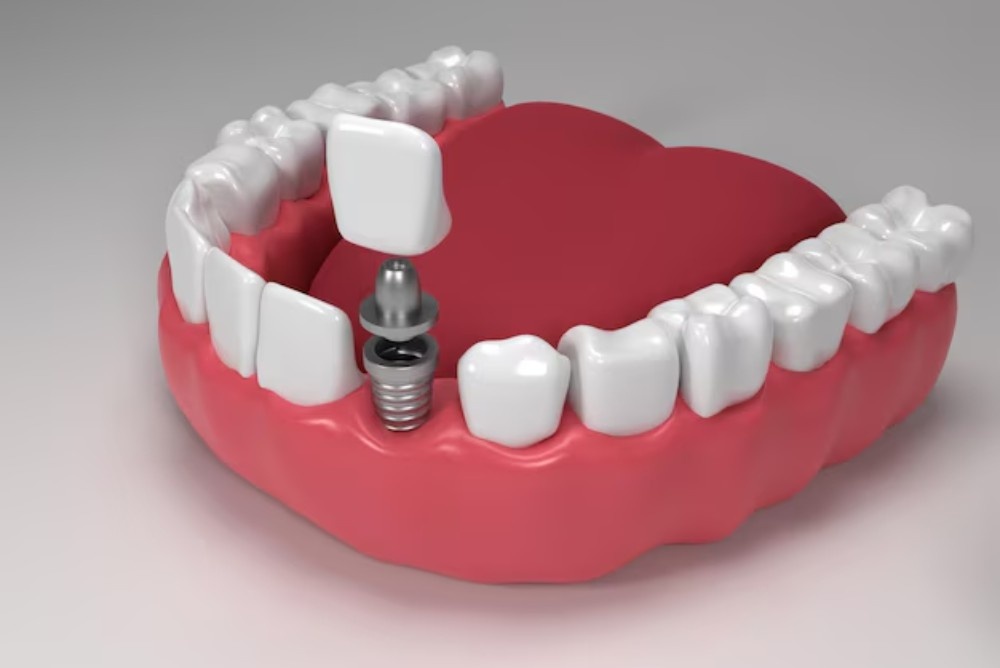 Why Is Bone Grafting Needed For Dental Implants?