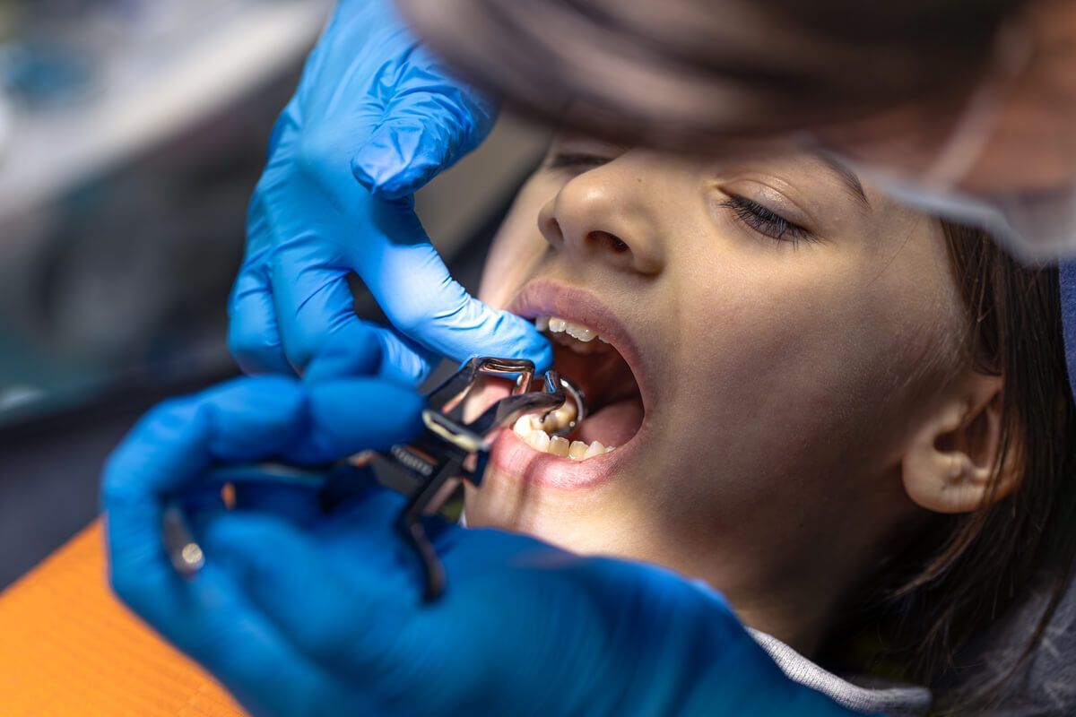 child undergoing tooth extraction procedure during pediatric dental treatment